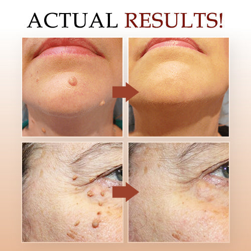 ⭐𝐂𝐥𝐞𝐫𝐚𝑳𝒖𝒙𝒆™ Tags & Moles Remover